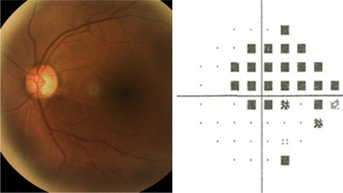 Figure 1 Example of a case of POAG with inferior retinal nerve fiber layer defect characterized with a superior arcuate defect on VF.