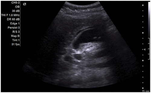 Figure 2a. Abdominal ultrasound: image showing signs of cholecystopancreatitis with enlarged gallbladder and thickened wall. Fluid is seen adjacent to the gallbladder. Numerous gallstones are present within, the largest at 6 mm.