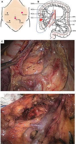 Figure 1 Demonstration of D3 lymphadenectomy for laparoscopic right hemicolectomy.Notes: (A) Position of five operative ports; (B) Scope of D3 lymphadenectomy according to various surgical methods. The direction following the red arrow indicates the SLRC method, whereas that direction following the blue dotted arrow indicates the conventional SMV-guided LRC method. The blue short line indicates the cutting edge of distal bowel. (C) The typical D3 lymphadenectomy and vessel skeleton on basis of SLRC technique. LN dissection was started from the inside of SMA with a caudal-to-cranial medial approach (the dotted line). Several tributaries of SMV and SMA were ligated after sufficient space dissection (1. Ileocolic vein; 2. SMV trunk or surgical trunk; 3. Root of ileocolic artery; 4. SMA trunk; 5. Superficial dorsal vein of pancreas; 6. Root of arteria colica media; 7. Henle trunk, also known as gastrocolic trunk; 8. Head of pancreas; 9. Horizontal part of duodenum; 10. Hepatic flexure). (D) The typical D3 lymphadenectomy and vessel skeleton on basis of CLRC technique. The SMA is not exposed routinely by using this technique. The dotted line stands for the inside region of lymph node dissection beyond the SMV. Those numbers indicate vessels and organs (1. Ileocolic vein; 2. SMV trunk or surgical trunk; 3. Root of ileocolic artery; 6. Root of arteria colica media; 7. Henle trunk, also known as gastrocolic trunk; 8. Head of pancreas; 9. Horizontal part of duodenum).Abbreviations: CLRC, conventional laparoscopic right hemicolectomy; ICA, ileocolic artery; IIA, inner iliac artery; IMA, inferior mesenteric artery; LCA, left colic artery; LRC, laparoscopic right hemicolectomy; MCA, middle colic artery; RCA, right colic artery; SLRC, SMA-guided LRC; SMA, superior mesenteric artery; SMV, superior mesenteric vein; SRA, superior rectal artery.