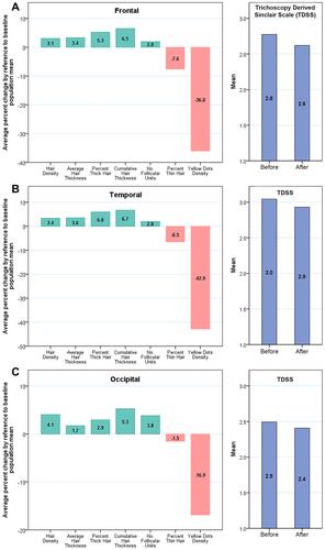 Figure 2 Change in key indicators of hair growth, by scalp region, in male and female androgenic alopecia after treatment with autologous cellular micrografts (ACM). Pictures depict: 1) relative pre- to post-intervention change (in percent, left panels) of the 5 positive (green bars) and 2 negative (Orange bars) parameters as adjusted by the respective baseline population mean, that is, bar heights represent the percentage of change in the given parameter by reference to the baseline population mean; 2) mean derived Sinclair grade (right panels) in baseline versus after treatment with ACM. Panels correspond to findings in different scalp regions including frontal (A), temporal (B), and occipital (C) regions.