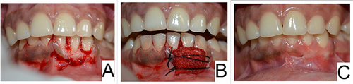 Figure 3 (A) Immediate Post-operative photograph after surgical excision of the lesion. (B) Collagen sponge dressing sutured over the surgical excision site. (C) One-month post-operative photograph showing a well healed surgical site.