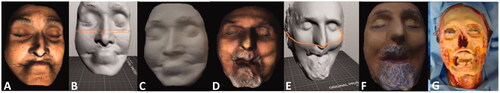Figure 1. A,D) 3D facial reconstruction with stereophotometry technique. B,E) Representation of the 3D file optimized for 3D printing. The orange line shows the thickness of the printing layer. C) 3D printed donor site prosthesis, PLA material, unpainted. F) Final prosthesis. G) Donator of facial tissues. H) Dignification of cadaver with 3D printed mask.