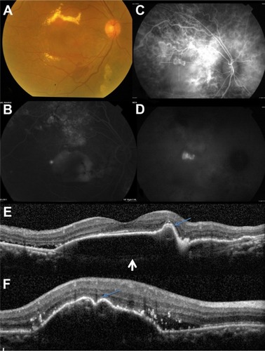 Figure 2 The right eye of a 75-year-old male (case 7) with polypoidal choroidal vasculopathy initially diagnosed with central serous choroidopathy.