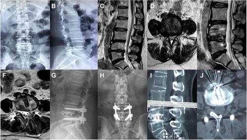 Figure 6 Images were obtained from a 51-year-old female patient with the lumbar spinal stenosis at L4-5. (A–D) Preoperative X-rays and MRI images showing lumbar spinal stenosis at L4-5; (E and F) Postoperative sagittal and axial MRI images showing complete decompression after full Endo-PLIF; (G and H) Postoperative anteroposterior and lateral X-rays at 3 months showing correct position; (I and J) Postoperative sagittal and axial CT images at 6 months showing interbody fusion.