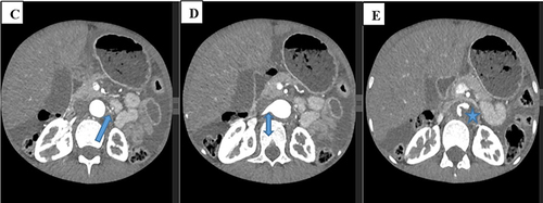 Figure 2 Axial sections of abdominal CT angiography (C–E) showing severe left renal artery narrowing (arrow in C) compared to the right renal artery (double arrow in D). There is also a thrombosed aneurysm of the abdominal aorta (star in E). Moderate free peritoneal space collection is also visible.