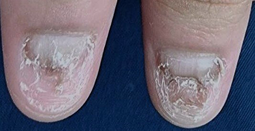 Figure 2 After receiving one PDL treatment, remarkable improvements in the appearance of the nail plate, nail bed, and surrounding skin can be noticed.
