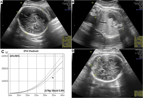 Figure 1 Ultrasonography results showing fetal growth measurements. (A) Head circumference (gestational age 36 weeks 4 days) and biparietal diameter (gestational age 36 weeks 1 day). (B) Abdominal circumference (gestational age 33 weeks 3 days). (C) Estimated fetal weight <10th percentile on fetal growth curve. (D) Transcerebellar diameter (gestational age 35 weeks 4 days).