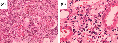 Figure 1.  Renal biopsy with histological staining [(A) hematoxylin–eosin, ×200; (B) periodic acid-Schiff, ×400] revealed massive interstitial infiltration by inflammatory cells mainly composed of lymphocytes and plasma cells. The glomeruli showed a mild mesangial hypercellularity.