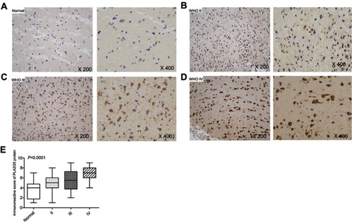 Figure 2 PLA2G5 protein expression in glioma examined by immunohistochemistry. (A)-(D) Immunohistochemical staining images of grade II, III and IV glioma tissues and non-tumor brain tissues (magnification ×200 and ×400); (E) The immunohistochemical score indicates that PLA2G5 protein expression was dependent on WHO grade.