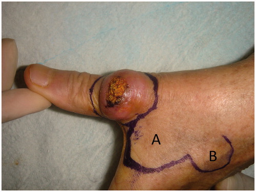 Figure 1. Preoperative view of the lesion and planning of bilobed flap.