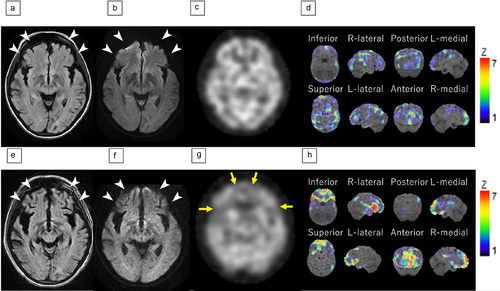 Figure 1. Brain MRI and SPECT.