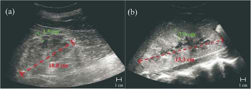 Figure 1. Ultrasound images of a healthy kidney (A) and a kidney with AKI (B). Kidney length (red) and parenchymal thickness (green) are shown and are some AKI indicators.