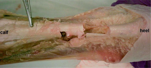 Figure 1. Failure of percutaneous tendon lengthening by triple hemisection technique. The proximal cut (near the scissor) did not slide, and the distal cut ruptured during the sliding procedure.
