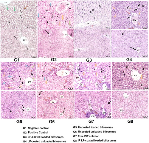 Figure 13. Hematoxylin and eosin staining of liver cancer tissues of 8 study groups; G1 (negative control), G2 (positive untreated control), G3-7 treated groups with oral administration of different formulae where G3 (LF-coated loaded), G4 (LF-coated unloaded), G5 (uncoated unloaded), G6 (uncoated unloaded), G7 (free PIT solution) and G8 (Same formula as in G3 ‘LF-coated loaded formula’ but administered IP rather than orally). (*) hyper eosinophilia, (?) binucleated, (K) Kupfer cells, (#) high N/C ratio, (CV) central vein, (PT) portal vein, (BV) blood vessel. (H&E stain, Mic. Mag. × 200, and × 400).