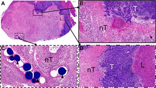 Figure 3 (A) Representative HE staining of the tumor after TACE. (B) Showing the necrosis of tumor tissue and liver tissue (100×); (C) showing the callispheres beads (100×, black triangle); (D) showing three primary tissues (100×).