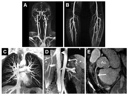 Figure 2 Example of a healthy proband whole-body MRA: compilation of a gadofosveset-enhanced whole-body MRA with acquisition of the carotid arteries (A) and the lower thigh arteries (B) in the dynamic and first-pass phase (for acquisition parameter refer to Table 1), as well as acquisition of the thoracic area (C, voxel size 1.0 mm3, acquisition time: 37 seconds), abdomen (D, voxel size 1.0 mm3, acquisition time: 35 seconds). The signal-to-noise ratio that can be achieved in the equilibrium phase is even sufficient for satisfactory imaging of the coronary arteries (E, voxel size: 0.7 mm3, navigator technology, acquisition time: 3:30 min). Ao: aorta; arrow: right coronary artery. Image courtesy Konstantin CitationNikolaou, reproduced from Mathias Goyen (ed.). 2006. Vasovist – the first intravascular contrast agent for MR angiography, ABW-Wissenschaftsverlag Berlin.
