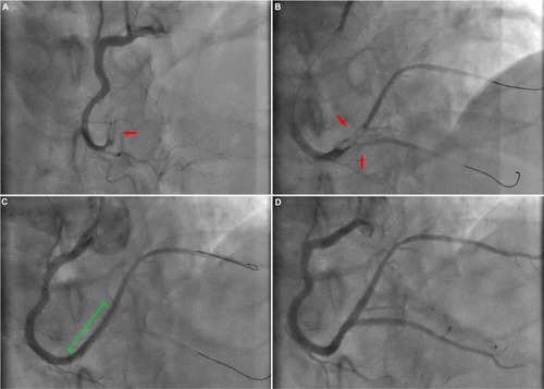 Figure 2 Coronary angiogram (30° cranial oblique projection) showing a totally occluded right coronary artery before intervention (A). Despite exhaustive thrombus aspiration. Red arrow points to the thrombotic total occlusion. (B), a high thrombus burden (TIMI thrombus score =4) persisted at the bifurcation (red arrows). After MGuard deployment (green line), TIMI 3 flow was restored to the posterolateral branch, although the posterior descending artery persisted totally occluded (C). Following “reverse T stenting,” final TIMI flow was 3 in both the posterior descending artery and the posterolateral branch branches (D, final result).