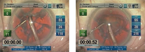 Figure 7 Removal of the second and subsequent quadrants of relatively firm soft lenses using the Quadrant Removal Setting.