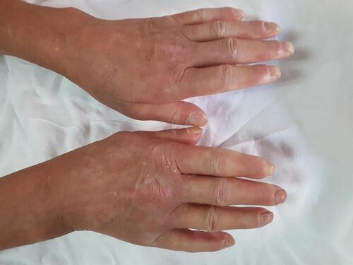 Figure 1 Sclerodactyly and digital contracture in flexion.