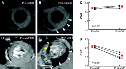 Figure 5 MRI images acquired in short-axis view in a rat model of acute myocarditis.Notes: (A–B) T1-weighted Gd contrast-enhanced images and corresponding CNR diagram (C); (D–E) T2*-weighted acquisitions before and after MNP application (~85 nm in-house synthesized) and corresponding CNR diagram (F). Inflammation-associated contrast enhancement is visualized with the white arrowheads (B and E) in the left ventricular wall. Images of MNP-treated rats show significantly larger changes in CNR determined in left ventricular wall. Yellow arrows mark in (E) the inflammatory spots not found in post-Gd images but present in post-MNP acquisitions. (C and F) black indicates individual values and red indicates mean value. Republished with permission of American Heart Association, from Noninvasive assessment of myocardial inflammation by cardiovascular magnetic resonance in a rat model of experimental autoimmune myocarditis; Moon H, Park HE, Kang J, et al; 125(21), 2012; permission conveyed through Copyright Clearance Center, Inc.Citation71Abbreviations: CNR, contrast-to-noise ratio; Gd, gadolinium; MNP, magnetic nanoparticle; MRI, magnetic resonance imaging.