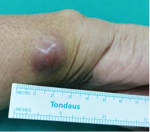 Figure 1 A red-to-violet subcutaneous nodule sized in the diameter of 2 cm on the right volar wrist.
