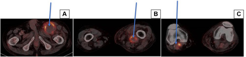 Figure 2 Axial section on PET-CT with FDG. Arrows show aneurysms. (A) Aneurysm on the left common femoral artery (SUV: 12), (B) Aneurysm on the left popliteal artery (SUV: 10), (C) Aneurysm on the right popliteal artery (SUV: 10).