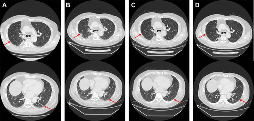 Figure 5 Chest CT scan of the interstitial pneumonia related to nivolumab treatment before and during the treatment course by acetylcysteine and corticosteroids. (A) Interlobular septal thickening and subpleural ground-glass opacities before the 16th cycle of nivolumab treatment (Red arrow). (B) Interlobular septal thickening and subpleural ground-glass opacities got worse in 3 months after nivolumab withdrawal (Red arrow). (C) Interlobular septal thickening and subpleural ground-glass opacities got better in 4 months since acetylcysteine and corticosteroids treatment (Red arrow). D. Interlobular septal thickening and subpleural ground-glass opacities disappeared in 4 months since acetylcysteine and corticosteroids withdrawal (Red arrow).