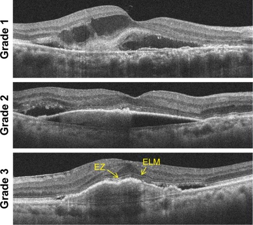 Figure 1 Assessment of optical coherence tomography images of patients with age-related macular degeneration treated with intravitreal aflibercept.