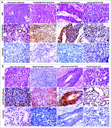 Figure 4. Validation of SPAG9 protein expression in various histotypes of malignant SGT by immunohistochemistry. (A) Top panel showing the cytostructure of representative specimens of benign pleomorphic adenoma and various malignant histotypes such as mucoepidermoid carcinoma, adenoid cystic carcinoma and acinic cell carcinoma of SGT stained with H&E. Middle panel shows cytoplasmic localization of SPAG9 protein expression in the representative specimens of various histotypes of SGT probed with anti-SPAG9 antibody. Bottom panel depicts no immunoreactivity for SPAG9 protein in various histotypes of SGT specimens when probed with control IgG. (B) Top panel showing the cytostructure of representative specimens of various malignant histotypes such as clear cell carcinoma, basal cell carcinoma, adenocarcinoma not otherwise specified and polymorphous low grade adenocarcinoma of SGT stained with H&E. Middle panel shows cytoplasmic localization of SPAG9 protein expression in the representative specimens probed with anti-SPAG9 antibody. Bottom panel depicts no immunoreactivity for SPAG9 protein when probed with control IgG. Original magnification: x400; objective: x40.