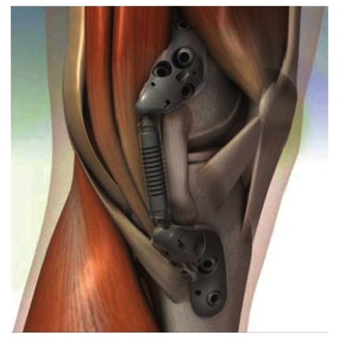 Figure 2 Schematic of the KineSpring® Knee Implant System (Moximed, Inc, Hayward, CA, USA) in relation to key anatomical structures.