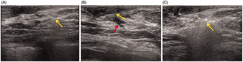 Figure 2. US imaging during MWA in the patient. (A) US shows 16 G core needle biopsy (arrow) of the hypoechoic lesion. (B) US showing the 22 G fine needle (yellow arrow) at the depth of the nipple for saline infusion (red arrow). (C) US showing the 16 G MWA needle (arrow) ablating the dilated duct and intraductal papilloma with the hyperechoic zone.