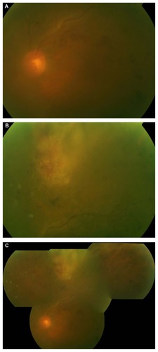 Figure 1 Color fundus photos showing: (a) Dilation, tortuousity, and sheathing along the superior venous arcade, with scattered flame-shaped and intraretinal hemorrhages; (b) 5 disc diameter white, granular-appearing lesion with intralesional hemorrhage in the superior periphery; (c) Composite image of the same eye.
