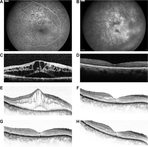 Figure 4 A 65-year-old female with regressed proliferative diabetic retinopathy in the right eye previously treated with three monthly injections of intravitreal bevacizumab.