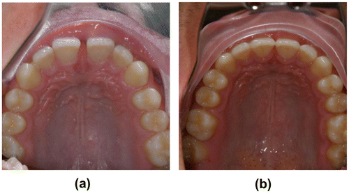 Figure 5 Patient presented with generalized spacing of the upper arch in A. Spacing was closed in the anterior and placed between the upper second bicuspid teeth and first molar teeth without retracting or reducing the arch circumference in B.