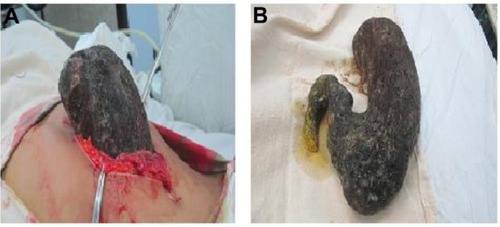 Figure 2 Surgical removal (A) of a stomach shaped (B) bezoar in a mentally disabled female.