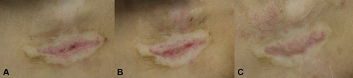 Figure 2 Female, 7 years old, (A) Is one month post-treatment, (B) Is three months post-treatment, and (C) Is six months post-treatment.