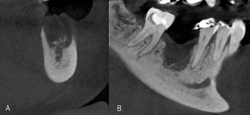 Figure 2 CBCT Transversal section (A) and Longitudinal section (B) of the tomography image showing the characteristics of the bone tissue after 3 months of implant removal.