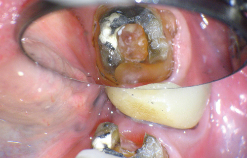 Figure 32. Intra operative pic after crown removed, showing complete calcification of the tooth.