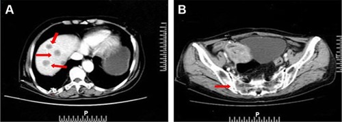 Figure 1 MRI findings of distant metastasis.