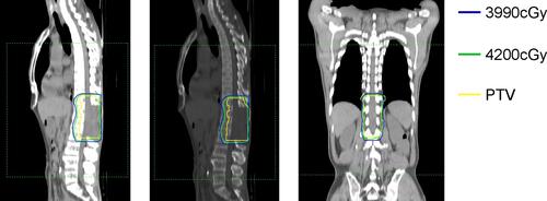 Figure 2 Dose distribution of three-dimensional conformal radiotherapy plan. Radiotherapy dose distribution is depicted as isodose levels. Planning target volume (PTV) is outlined in yellow.