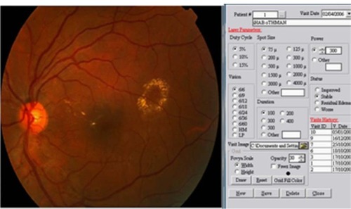 Figure 1 Software used to import the fundus image from the patient. The laser criteria used are selected from the menu.
