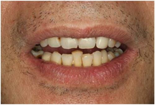 Figure 9 Open profile with denture.