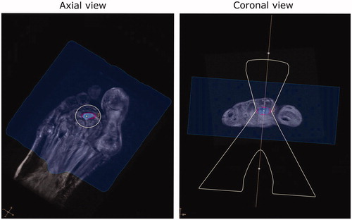 Figure 6. Case 15: MR image of a foot case with patient re-positioned to have the foot standing on the MRI table. The osteomyelitis site volume was 0.5454 ml, with a treated volume estimated at 0.50 ml by the planning software (91.7% coverage). The region in blue indicates the region attainable by the MRgFUS device. The focused ultrasound “acoustic beam” is delineated in yellow. The region in purple highlights the planning treatment volume.