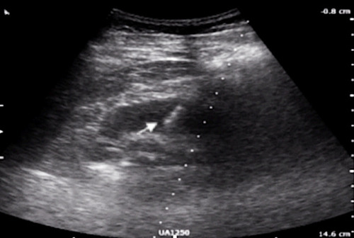 Figure 6 Ultrasound showed the tip of puncture needle (arrow) had reached the target calyx.