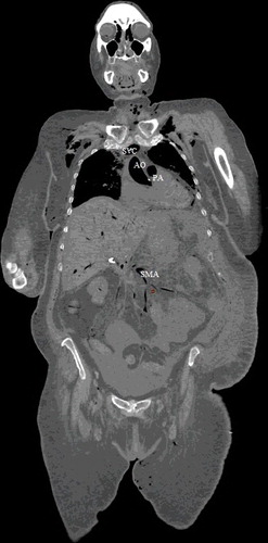 Figure 5. Coronal CT-soft tissue window: intravascular air in aorta (AO), pulmonary artery (PA), superior vena cava (SVC) and superior mesenteric artery (SMA). There is intravascular air in the liver and subcutaneous emphysema in the upper chest and neck soft tissues.