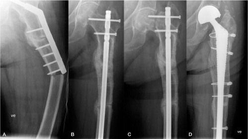 Figure 2. Implant-related fracture (panel A), treatment with intramedullary nail (B), failure of the neck of the femur and possible nonunion of diaphyseal fracture (C), and assumed definite treatment with long hydroxyapatite-coated stem (D).