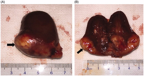 Figure 3. Gross pathological examination before MWA. (A) The tumor was located in the lower pole of the kidney (arrow). (B) The tumor was white in color on the cut surface (arrow).