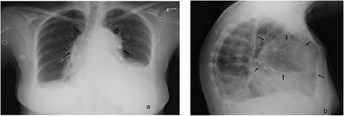 Figure 1. (a) Chest radiograph showing diffuse bilateral hilar adenopathy with questionable calcified granuloma at the hila (black arrows) noted in Figure 1 (a) and (b). This adenopathy obscures the hilum and the cardiac silhouette. There are bilateral pleural effusions, left greater than right, also appreciated. (b) The lateral view shows a large mass obscuring cardiac silhouette (black arrows) in the anterior compartment of the mediastinum.