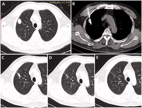 Figure 1. Axial CT images of a 71-year-old man with a 2.2-cm metastatic tumour in right lung from primary colorectal cancer. (A) Image obtained immediately before MWA, (B) image obtained during MWA, (C) image obtained 3 months after ablation, (D) image obtained 1 year after MWA and (E) image obtained 3 years after MWA.