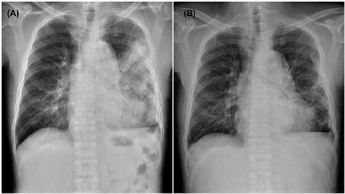 Figure 1. Chest plain films show patchy infiltrates and dense consolidation in the left lung upon admission (A) and apparent resolution of consolidation in the left lung on hospital day 15 (B).